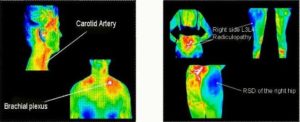 Thermography – Midwest Pain Treatment Center