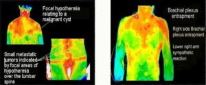 Thermography – Midwest Pain Treatment Center